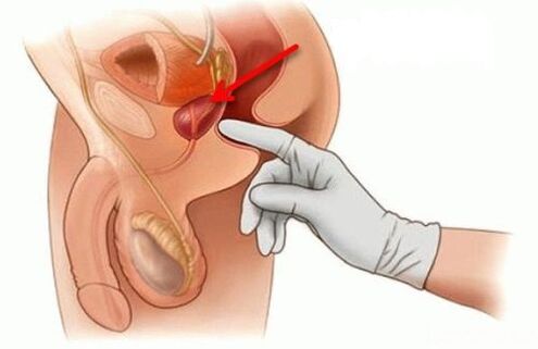 masaż prostaty na zapalenie gruczołu krokowego