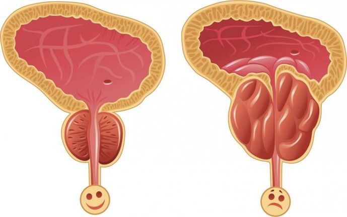 zdrowa i zapalona prostata z zapaleniem prostaty